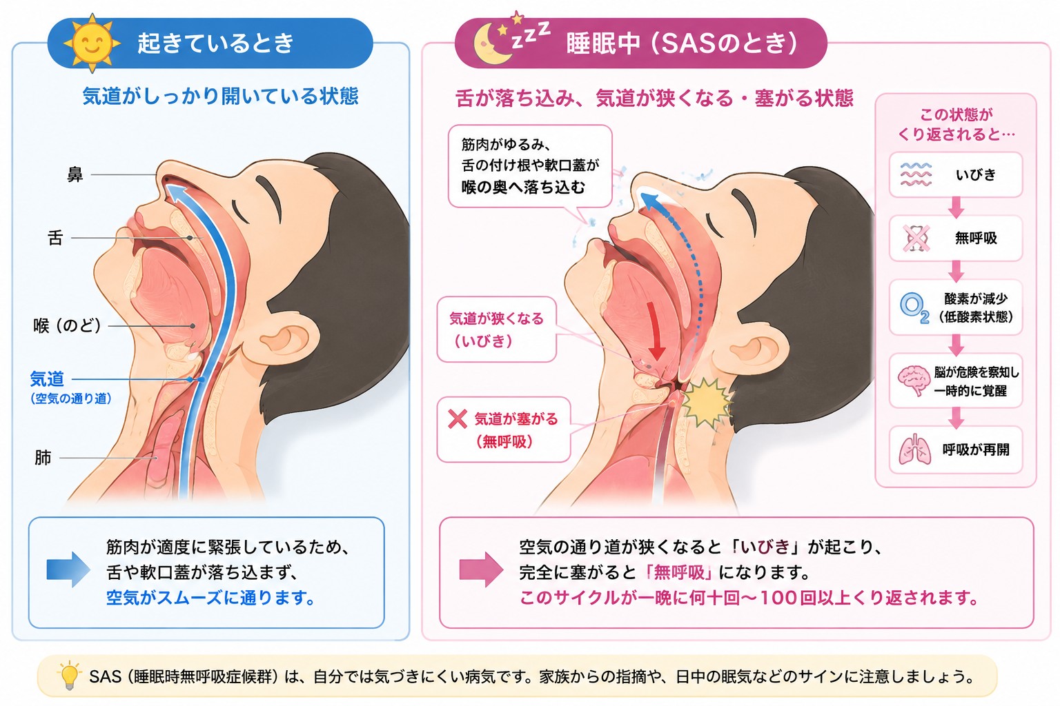 起きているときと睡眠中（SASのとき）の気道の状態を比較した図。睡眠中は舌が落ち込み気道が狭くなる・塞がる仕組みを示す