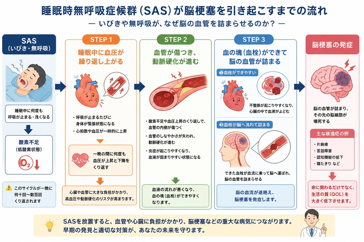 睡眠時無呼吸症候群（SAS）が脳梗塞を引き起こすまでの流れを示す図。血圧上昇、動脈硬化、血栓形成の3ステップで脳梗塞発症に至る経路を解説