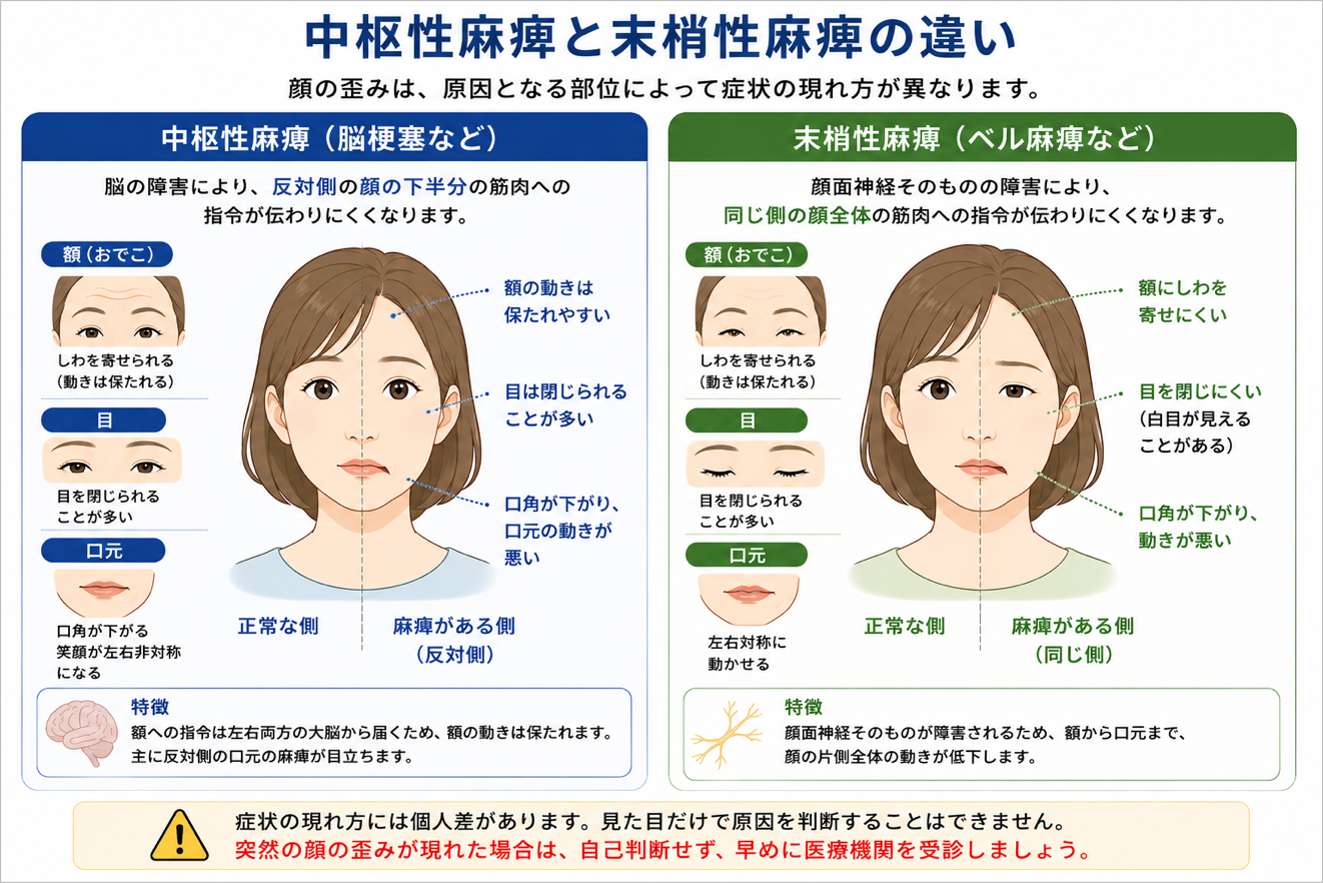 中枢性麻痺と末梢性麻痺による顔の歪みの症状の違いを、額・目・口元の状態で比較したイラスト図