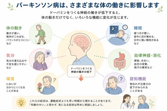 ドーパミンをつくる神経の働きが低下することで、体の動きだけでなく睡眠・気分・自律神経・消化・嗅覚・認知機能など全身に変化が生じる仕組みを表した説明図