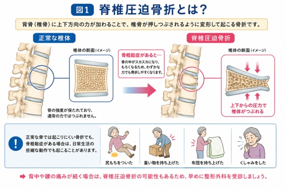 正常な椎体と骨粗鬆症による脊椎圧迫骨折を起こした椎体の断面を比較したイラスト。尻もちや重い物を持ち上げる、布団を持ち上げる、くしゃみといった日常動作で骨折することを示す図