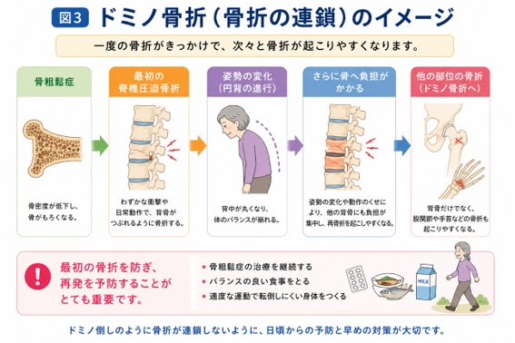 骨粗鬆症から最初の脊椎圧迫骨折、姿勢の変化（円背の進行）、他の骨への負担増加、股関節や手首など他部位の骨折へと連鎖していくドミノ骨折のイメージ図